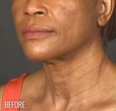 Neck Lift Before & After Patient #1161