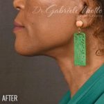 Neck Lift Before & After Patient #1161