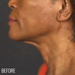 Neck Lift Before & After Patient #1161