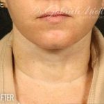 Neck Lift Before & After Patient #1162