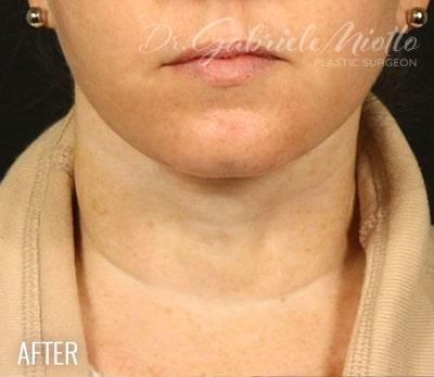 Neck Lift Before & After Patient #1162