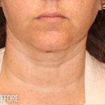 Neck Lift Before & After Patient #1162