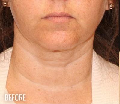 Neck Lift Before & After Patient #1162