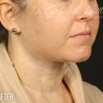 Neck Lift Before & After Patient #1162