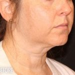 Neck Lift Before & After Patient #1162