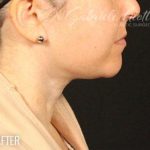 Neck Lift Before & After Patient #1162