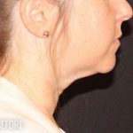 Neck Lift Before & After Patient #1162