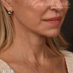 Facelift Before & After Patient #1163
