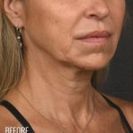 Facelift Before & After Patient #1163