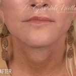 Neck Lift Before & After Patient #1091