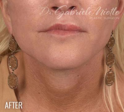 Neck Lift Before & After Patient #1091