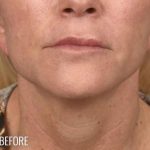 Neck Lift Before & After Patient #1091