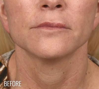 Neck Lift Before & After Patient #1091
