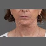 Neck Lift Before & After Patient #1112
