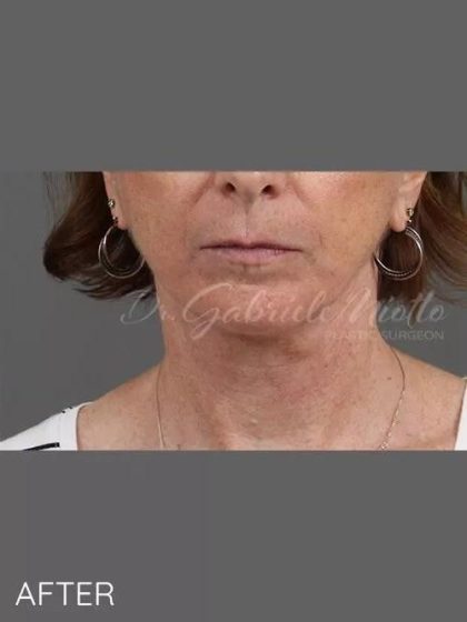 Neck Lift Before & After Patient #1112