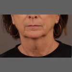 Neck Lift Before & After Patient #1112