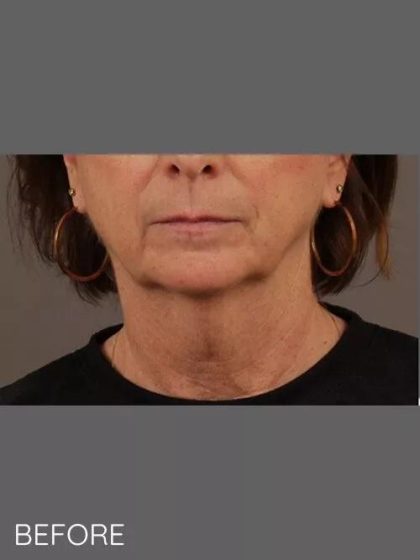 Neck Lift Before & After Patient #1112