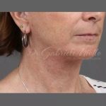 Neck Lift Before & After Patient #1112
