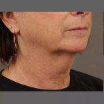 Neck Lift Before & After Patient #1112