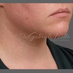 Neck Lift Before & After Patient #1098