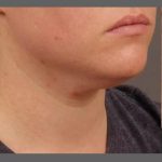 Neck Lift Before & After Patient #1098
