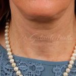 Neck Lift Before & After Patient #1138