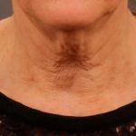 Neck Lift Before & After Patient #1138