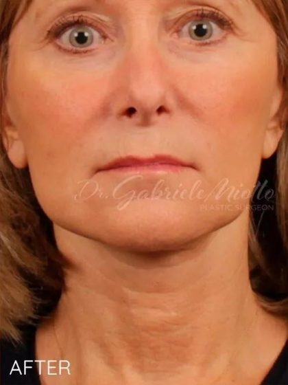 Facelift Before & After Patient #1140