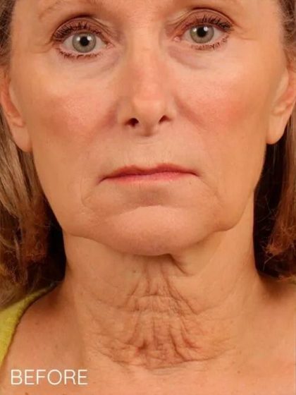 Facelift Before & After Patient #1140