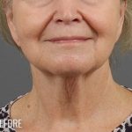 Neck Lift Before & After Patient #1139