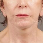 Neck Lift Before & After Patient #1137