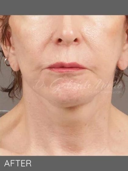 Neck Lift Before & After Patient #1137