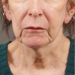 Neck Lift Before & After Patient #1137