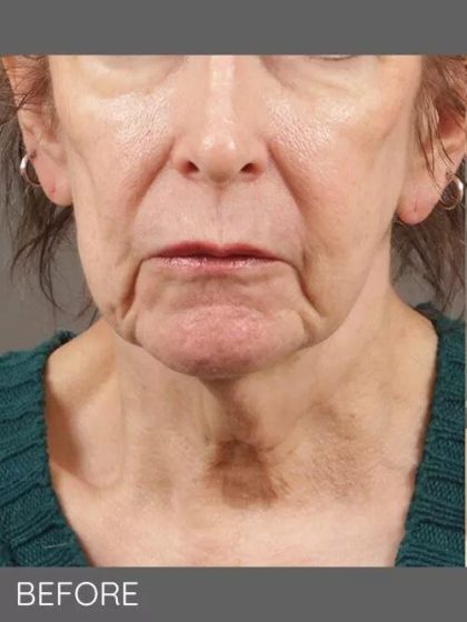 Neck Lift Before & After Patient #1137