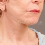 Neck Lift Before & After Patient #1137