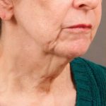 Neck Lift Before & After Patient #1137
