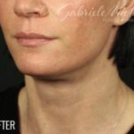 Neck Lift Before & After Patient #1136