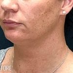 Neck Lift Before & After Patient #1136