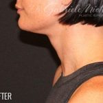 Neck Lift Before & After Patient #1136