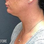 Neck Lift Before & After Patient #1136