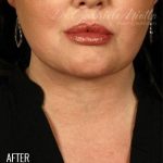 Neck Lift Before & After Patient #1158
