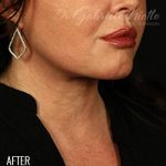 Neck Lift Before & After Patient #1158