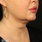 Neck Lift Before & After Patient #1158