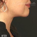 Neck Lift Before & After Patient #1158