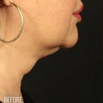 Neck Lift Before & After Patient #1158