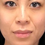 Non Surgical Rhinoplasty Before & After Patient #1314