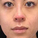 Non Surgical Rhinoplasty Before & After Patient #1314