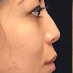 Non Surgical Rhinoplasty Before & After Patient #1314