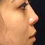 Non Surgical Rhinoplasty Before & After Patient #1314