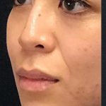 Non Surgical Rhinoplasty Before & After Patient #1314